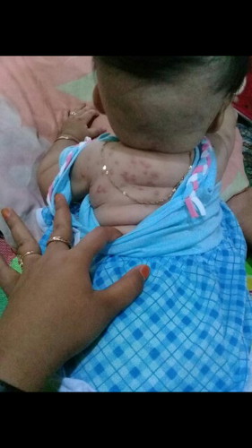 gatal gatal