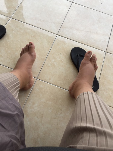 Kaki bengkak parah