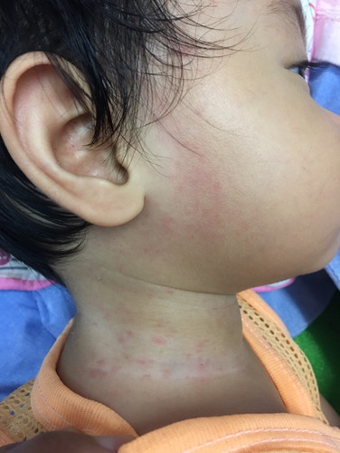 ผื่นขึ้นหลังจากหายเป็นไข้