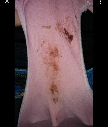 ถ้ามีมูกเลือดแบบนี้ออกหลังกระตุ้นปากมดลูกคืออะไรค่ะ