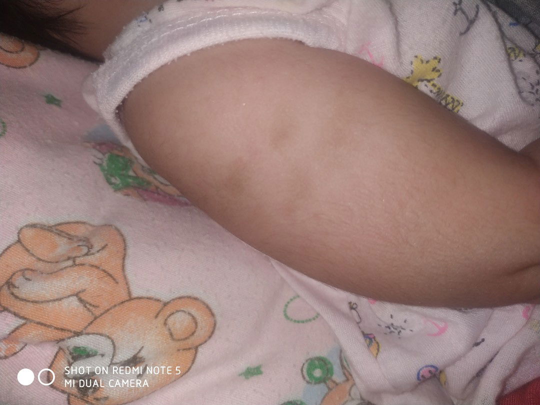 bekas gigitan nyamuk