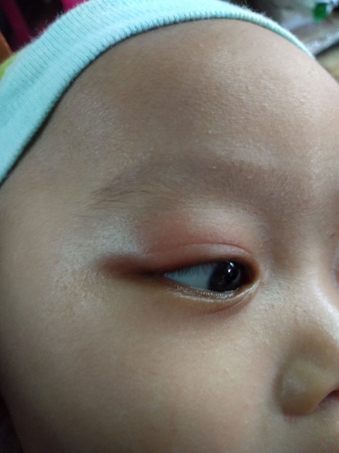 mata ankku digigit semut