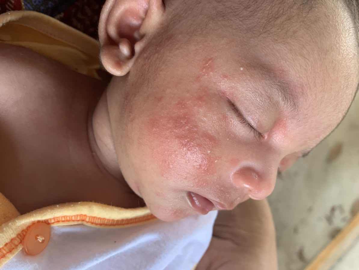 เป็นพื้นอะไรไม่รู้ทุกคนพอจะมีวิธีรักษาไหม