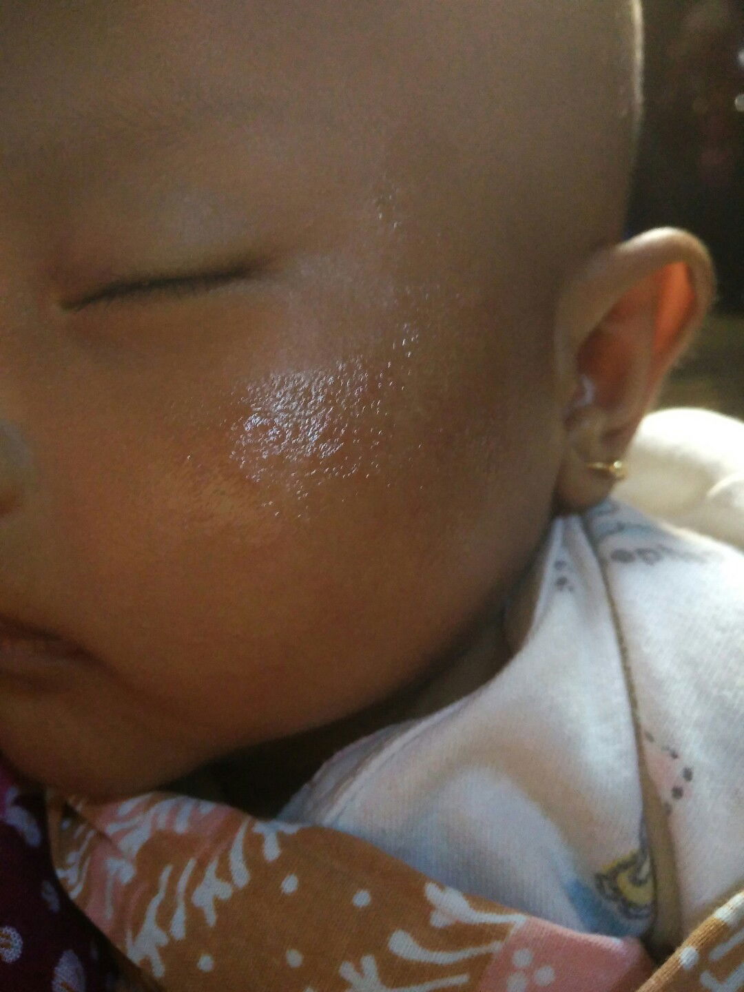 bintik merah di muka