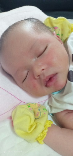 กลุ้มใจมาเลยค่ะน้องมีผื่นที่หน้า