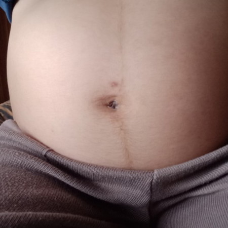 อยากให้ทายเพศลูกในท้องหน่อยสะดือแบบนี้ได้เพศหญิงหรือชายคะ ตอนนี้ลูกแอบอยู่จ้า6เดือนแล้ว
