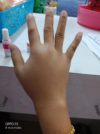 โดนผึ้งต๋อยที่ฝามือ จะมีผลต่อลูกในท้องไหมคะ