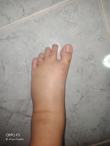 เท้าบวมคะ 8เดือน2วัน ไม่ทราบว่ามีผลต่อลูกในท้องไหมคะ เป็นห่วงลูกคะ