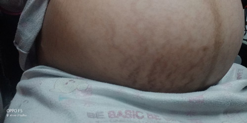 37+6 แบบนี้ท้องแตกลายไหมค่ะ