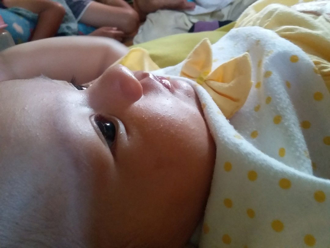 Bintik bintik d wajah bayi