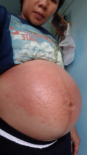 ใครเคยเป็นผื่นแพ้บ้างคะ ทำไงหาย หรือบรรเทาอาการคัน ตอนนี้ท้อง 34สัปดาห์+6 ค่ะ ตอนนี้ตุ่มใสเริ่มแตกมีน้ำเหลืองซึมด้วย