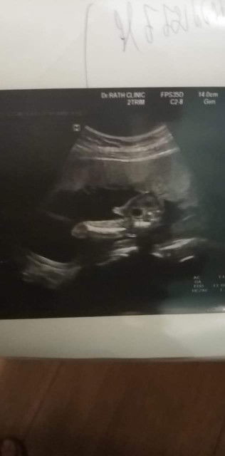 ผลอัลตร้าซาวด์