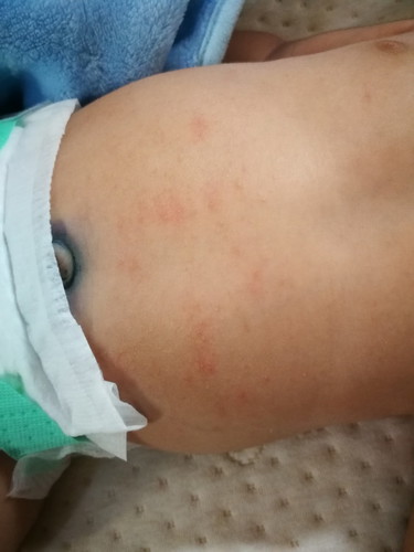 ลูกเป็นผื่น