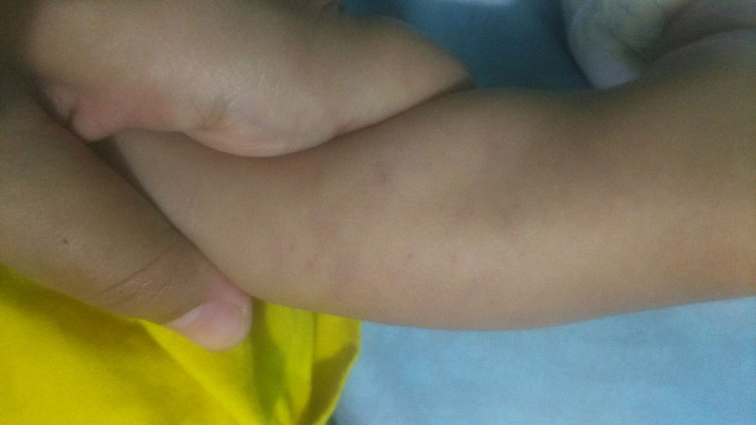 bintik biru pada kaki bayi