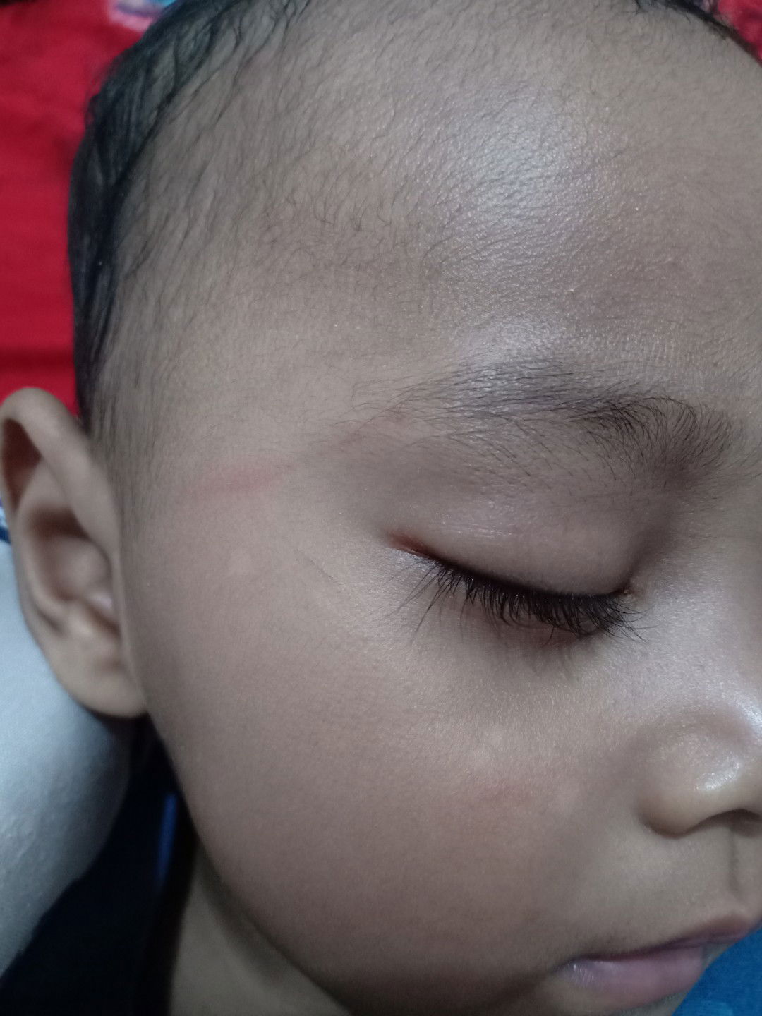 BINTIK PUTIH DI PIPI