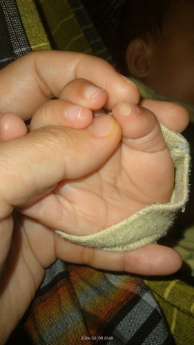 Solusi Kutil pada anak