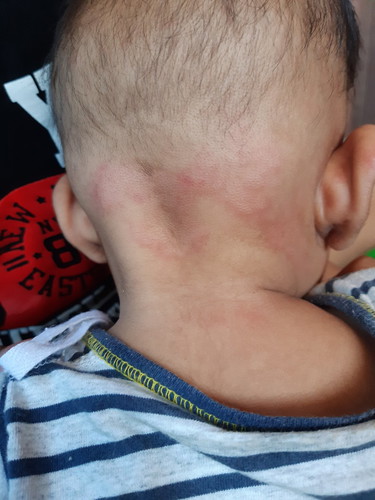 แบบนี้น้องเป็นภูมิแพ้รึป่าวคะ