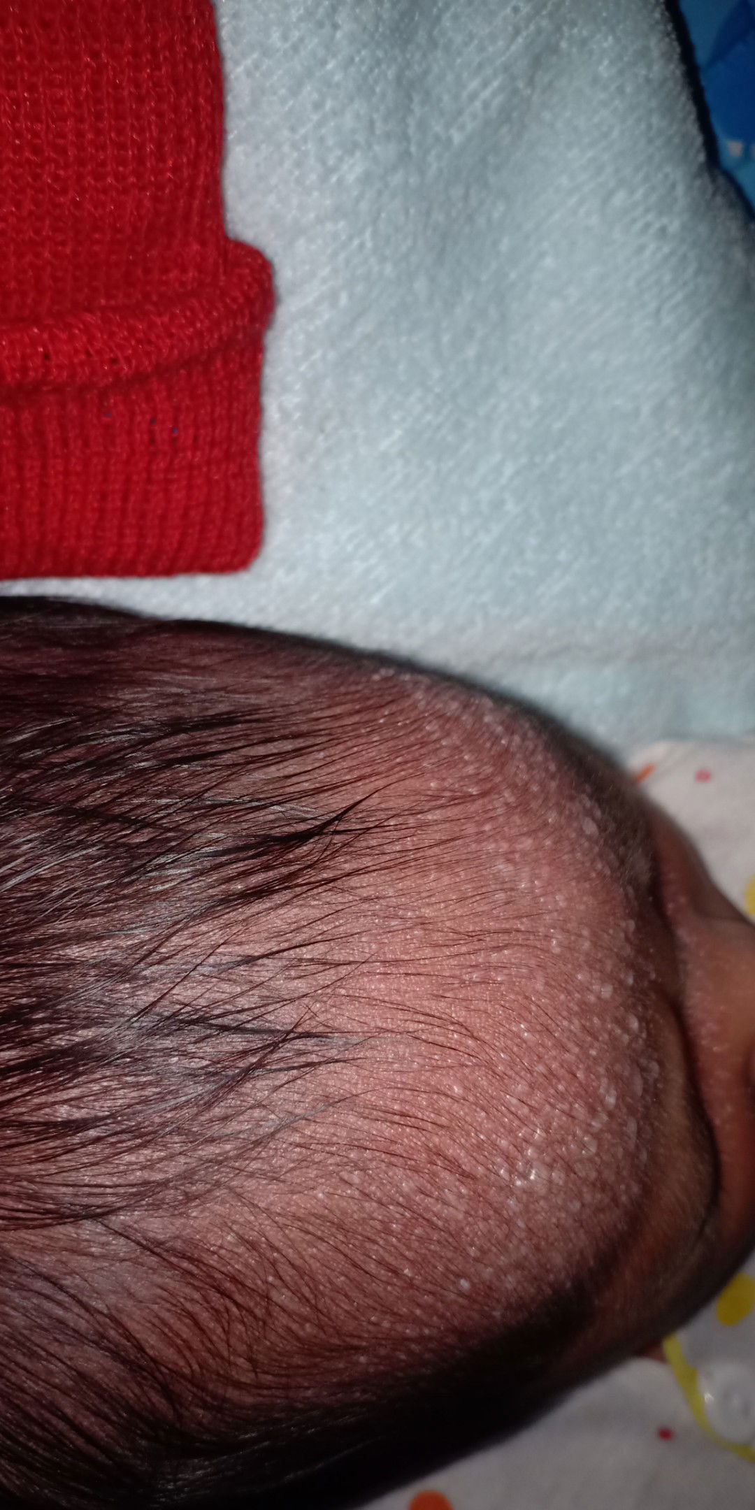 Bintik pada bayi 1 minggu