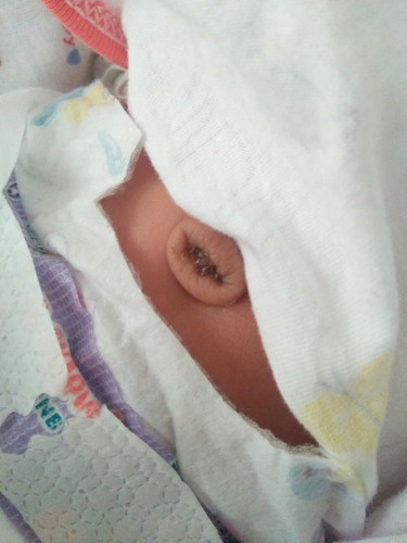 สะดือหลุด