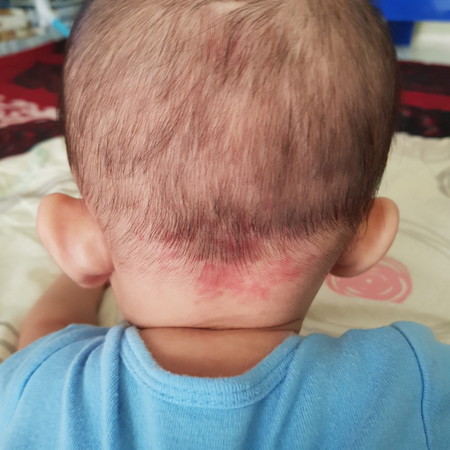 kemerahan ditengkuk kepala bayi