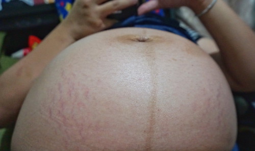 แม่ๆใช่ครีมแก้ท้องแตกลายยี่ห้อไหนคะ