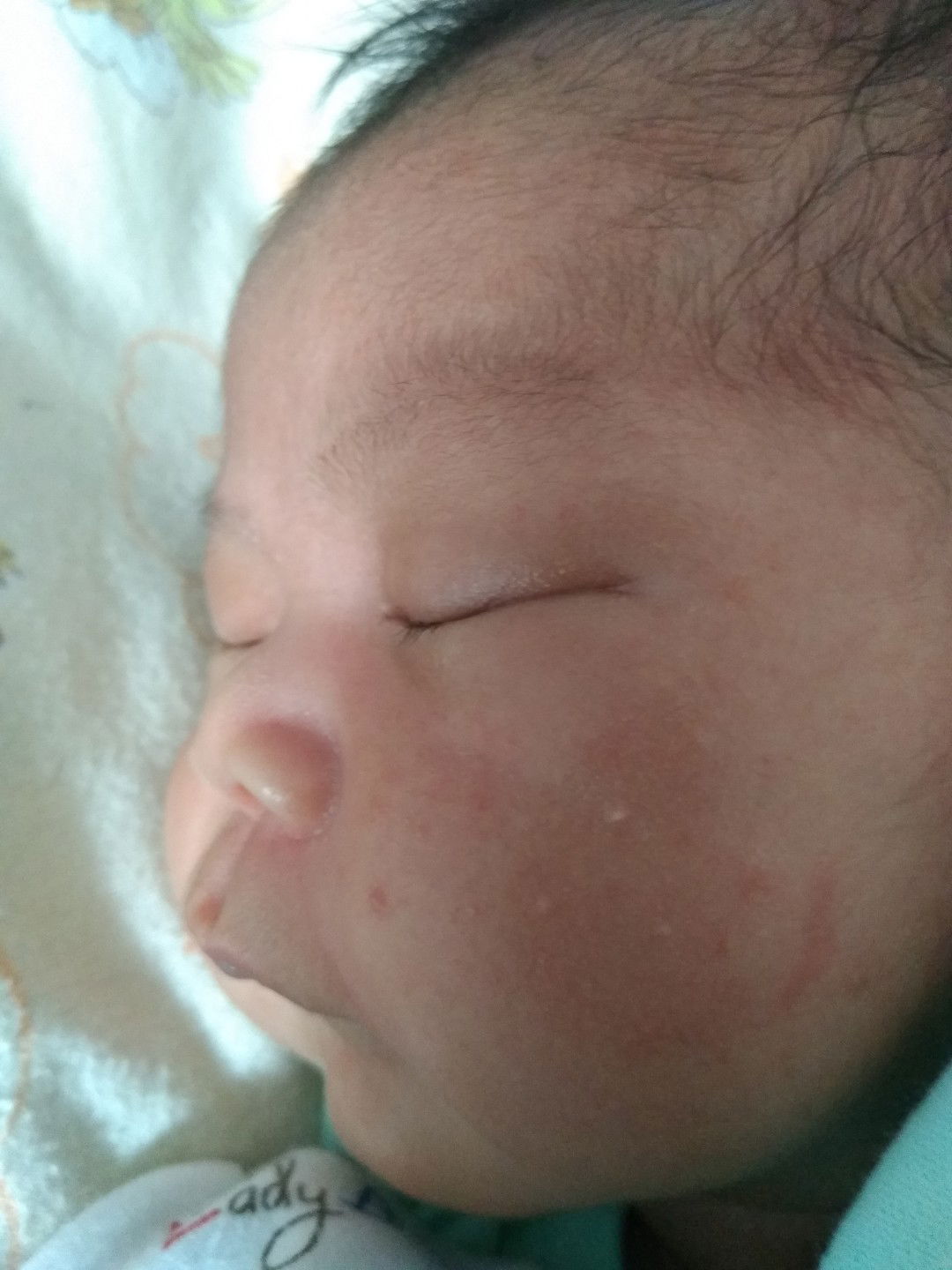 bintik merah pada bayi