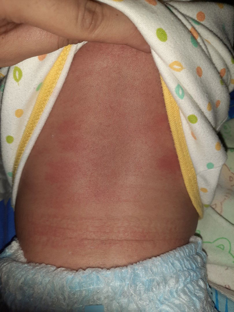 merah2 pada bayi