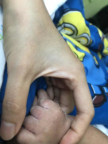 ตัวเป็นขุยๆมือลอก