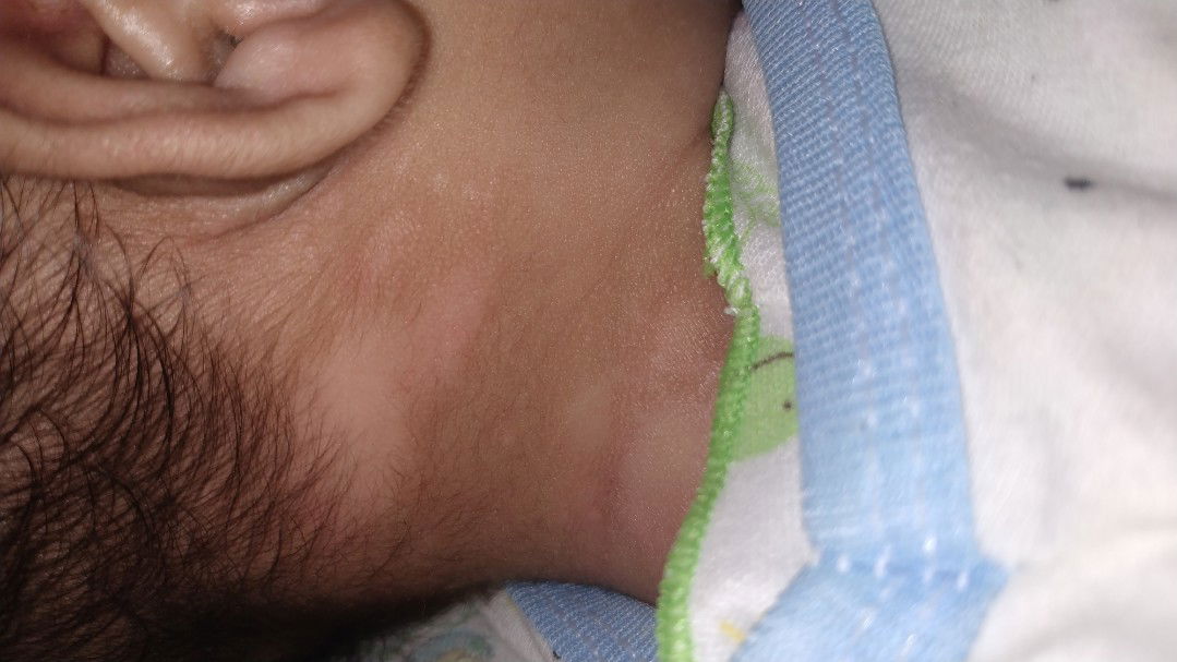 Bercak putih di leher