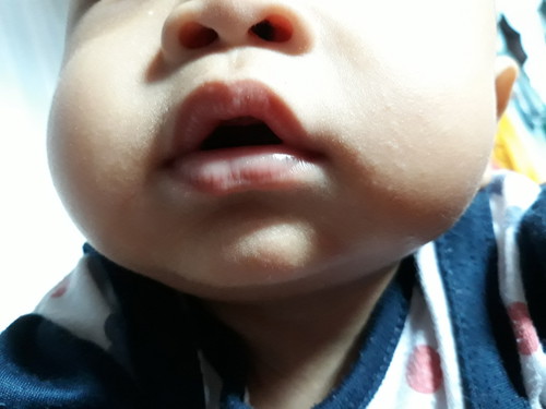 Alergi Bayi