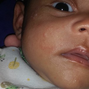 pipi ruam