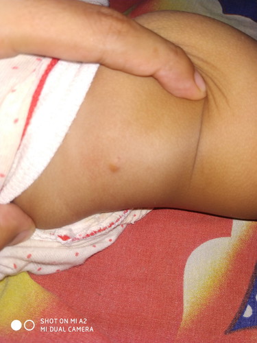 benjolan kecil