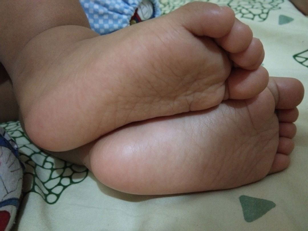 telapak kaki dan tangan kuning