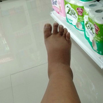 เท้าบวม