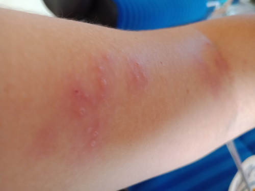 สอบแม่ๆค่ะ เรื่อง ผื่น