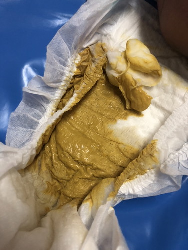 อุจจาระแบบนี้ปกติหรือท้องเสีย