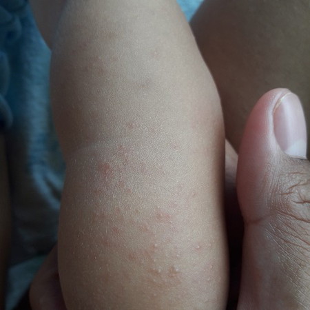 ลูกมีผื่นขึ้นเต็มตัวไม่รู้ว่าอันตรายไหมและมีวิธีรักษาหรือป่าวค่ะ