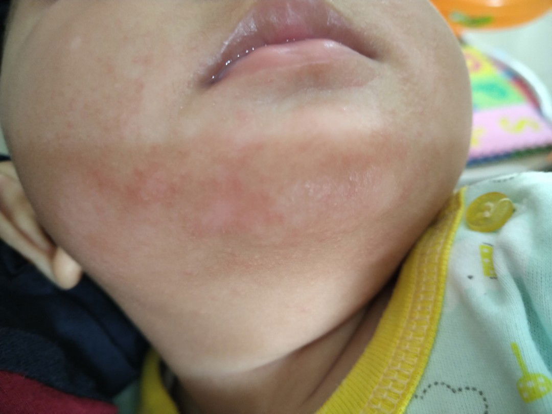 Kemerahan sekitar dagu sejak MPASI