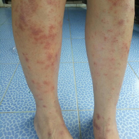 ผื่นคัน