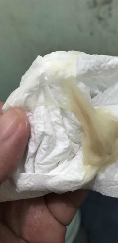 ปากมดลูกเปิด 4เซ็น อีกนานมั้ยคะกว่าจะเจ็บท้องคลอด