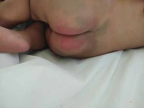 ผื่นแดง