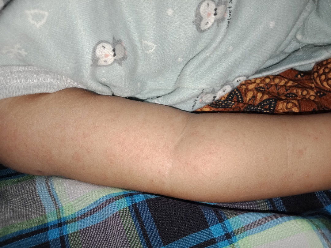 biang keringet atau tampek ya?