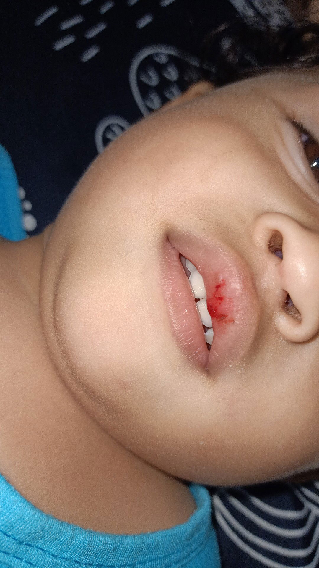 obat luka bibir aman untuk bayi