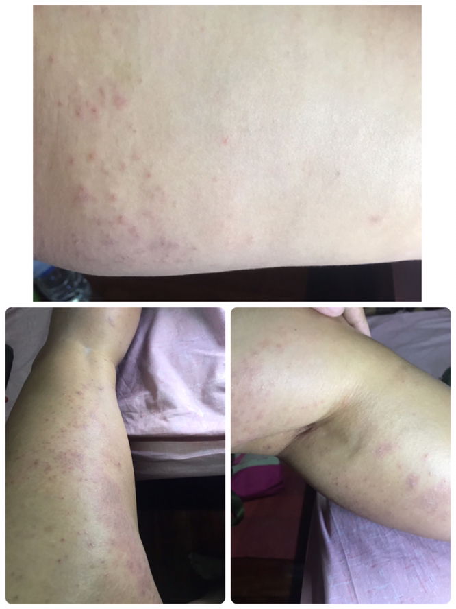 ผื่นคัน