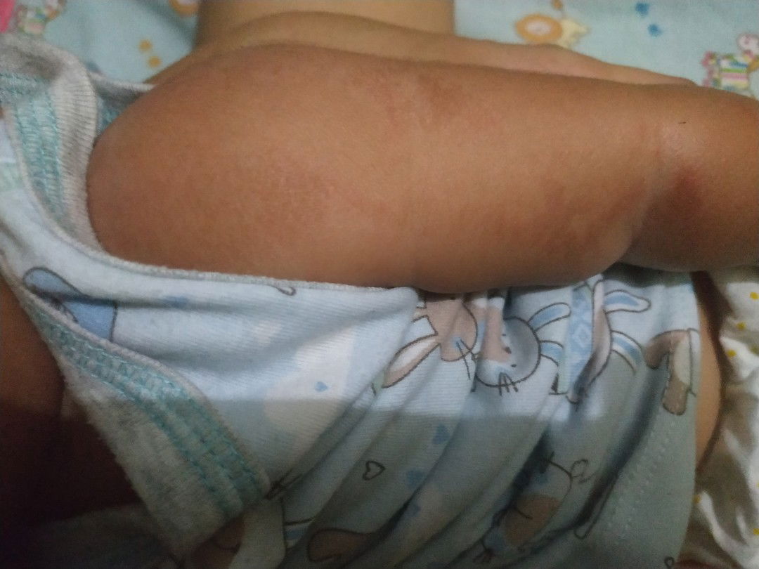 kulit kering menghitam