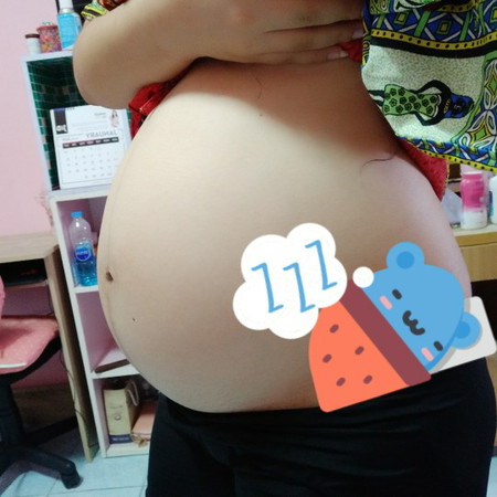มีใครท้องลายบ้างค่ะ แล้วจะท้องแตกลายกี่เดือนค่ะ