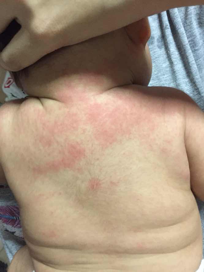 ผื่นแบบนี้ แพ้อาหารหรือผื่นร้อนธรรมดาทั่วไป