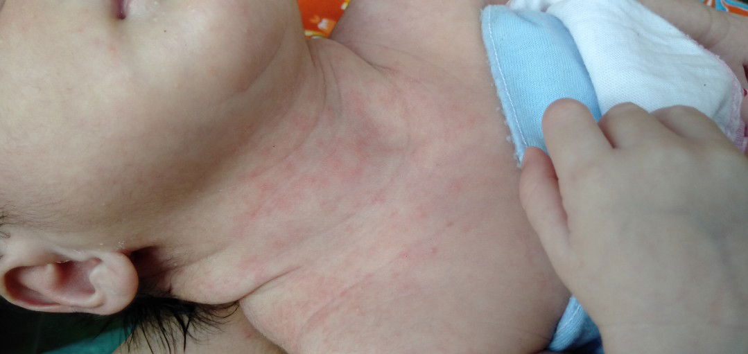 hawa panas bayi 13hari