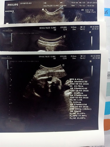 อายุครรภ์ 26+