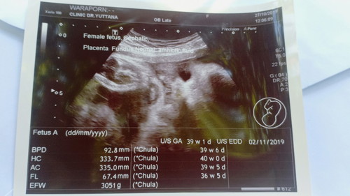 รกพัน1รอบแล้ว จะไปขอหมอกะตุ้นคลอดไม่รู้จะทำให้ไหม